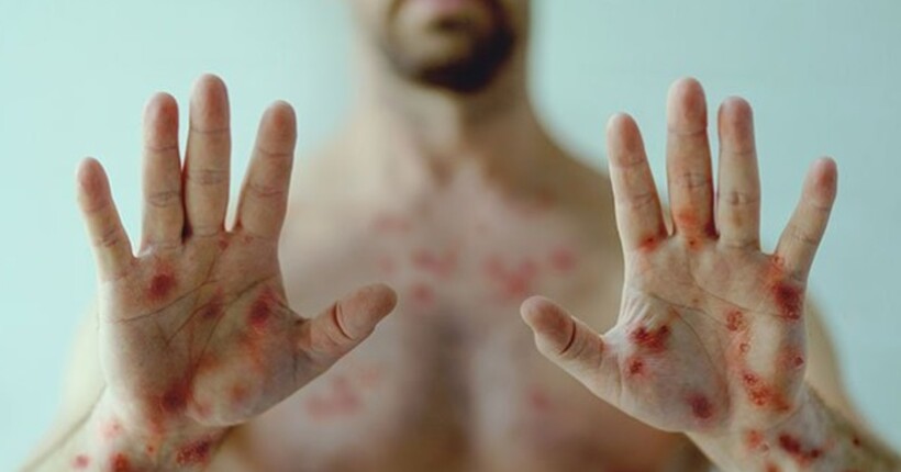 Нова загроза: ВООЗ б'є на сполох через смертоносний мутований штам вірусу mpox
